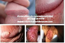 obat kutil kelamin,tanda kutil kelamin,gejala kutil kelamin,ciri ciri kutil kelamin,muncul kutil di sekitar kelamin,obat kutil tanpa operasi,cara menghilagkan kutil kelamin tanpa operasi