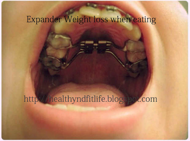How to help Palatal Expander Weight loss when eating 
