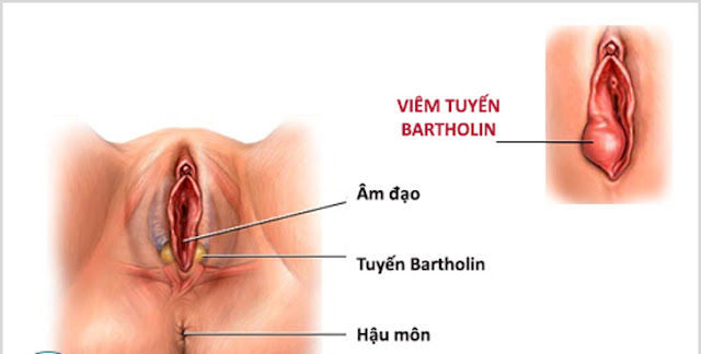 Nguyên nhân bệnh viêm tuyến Bartholin