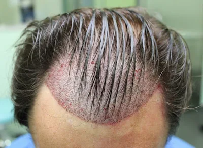 Trasplante de pelo: beneficios, técnicas, clínicas y riesgos