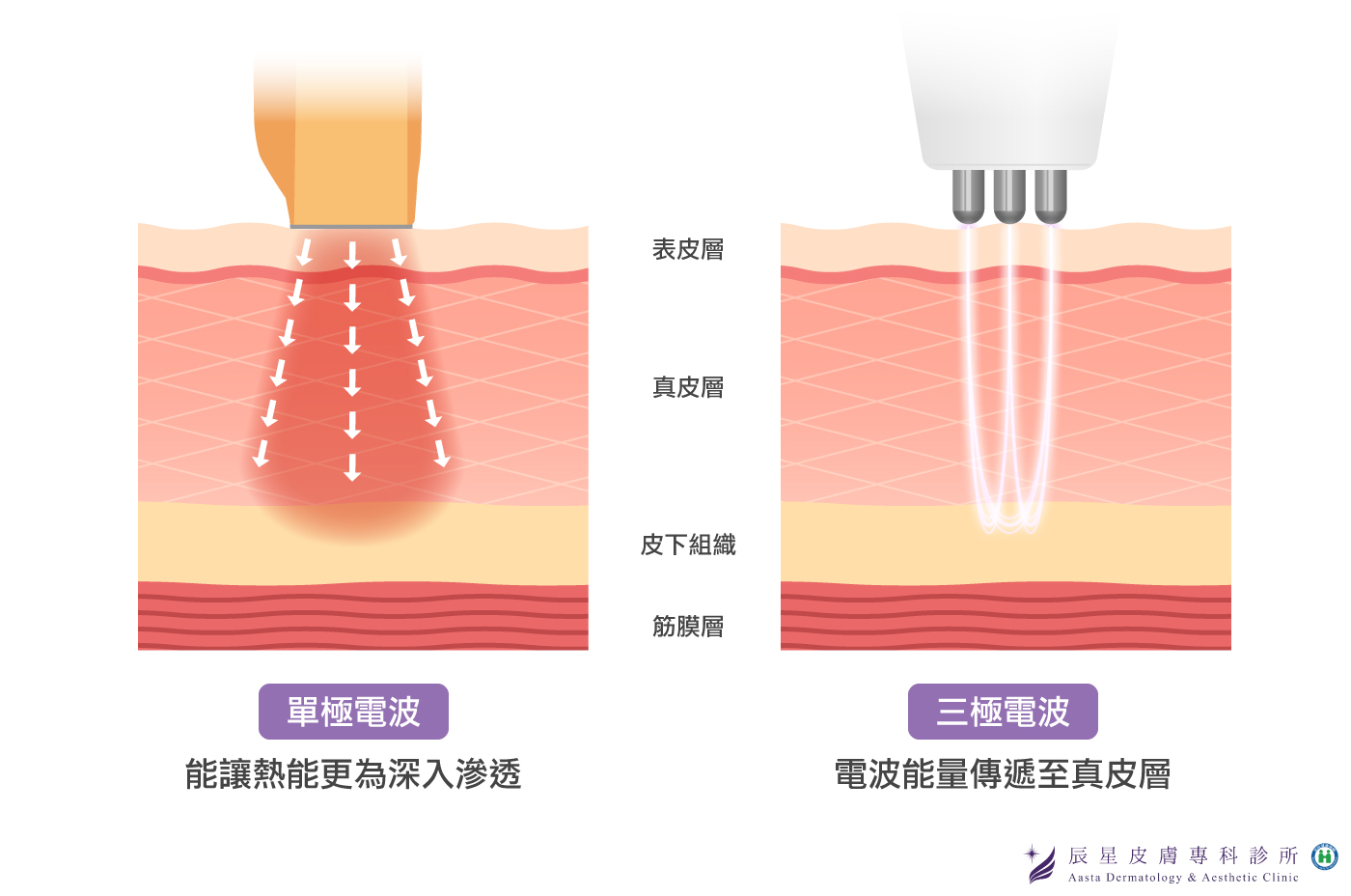 傳奇電波效果