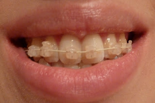 A front on photograph of teeth with ceramic fixed braces at week 4 of treatment