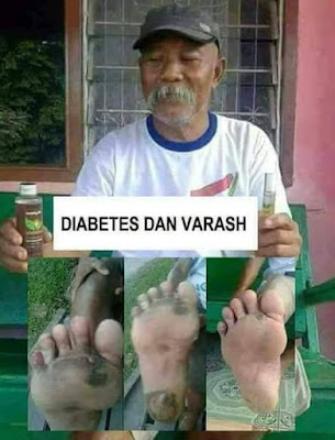 Terapi Dan penyembuhan penyakit Diabetes Menggunakan Produk Minyak Varash