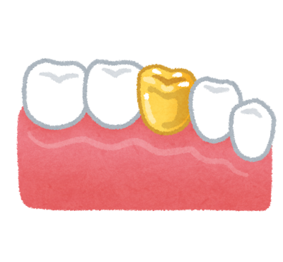 金歯のイラスト（歯の治療）