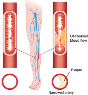 Limb Ischemia which leads to form Gangerines disease pictures