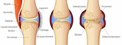 osteoarthritis