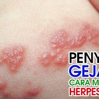 cara menghilangkan virus herpes genital