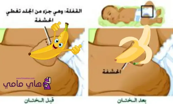 الشكل الطبيعي للعضو الذكري للطفل