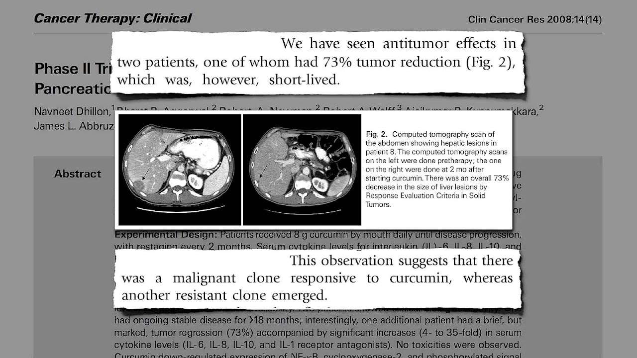 Pancreatic Cancer Alternative Medicine
