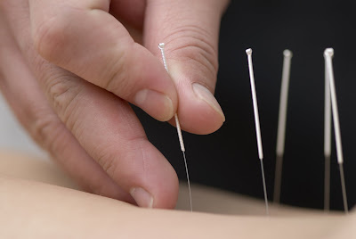 akupunktur tedavisi