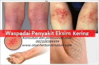 cara mengobati gatal,obat gatal atau eksim,obat eksim,cara menghilangkan gatal pada tangan,cara menghilangkan gatalk pada kaki