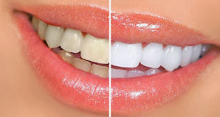 Trik Cara Memutihkan Gigi Secara Sehat dan Alami Tanpa Efek Samping