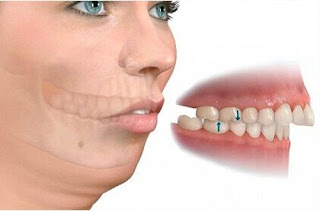 Cách chữa răng vẩu-1