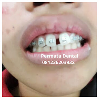 gambar foto behel bracket kawat gigi sebelum dan sesudah perawatan untuk memperbaiki merapikan gigi gingsul gigi miring renggang tonggos berantakan keluar masuk jarang diastema maju mundur tidak rapi tidak beraturan bali denpasar banyuwangi jember tidak rata kocar kacir