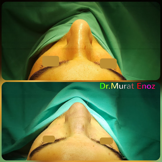 Male Nose Aesthetic Surgery in Turkey, Men's Rhinoplasty in Istanbul,Nose Job in Male Patient, Rhinoplasty in Men Istanbul,