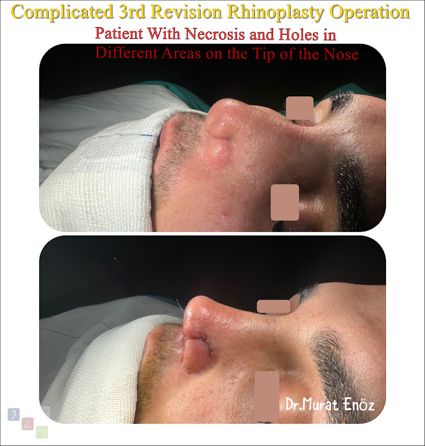 tertiary rhinoplasty, 3rd nose surgery, temporalis fascia technique, refined nasal aesthetics, expert revision cosmetic nose surgery, precision nasal enhancement, specialized rhinoplasty procedure.