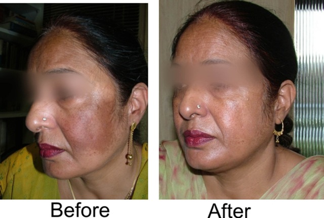Beauty Tips &amp; Personal Health Care: Pigmentation on face treatment
