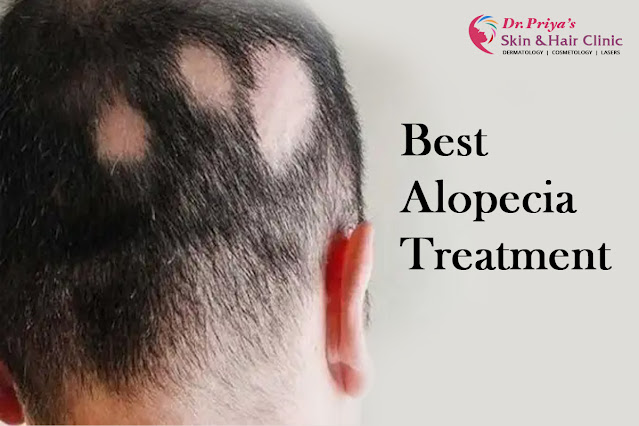 Best Alopecia Treatment In Bangalore