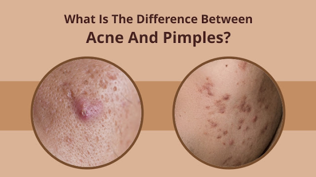 WHAT IS ACNE? CAUSES OF ACNES, SYMPTOMS, WHAT IS ACNE SCARS? DIFFERENCE BETWEEN ACNE AND PIMPLES? TREATMENT