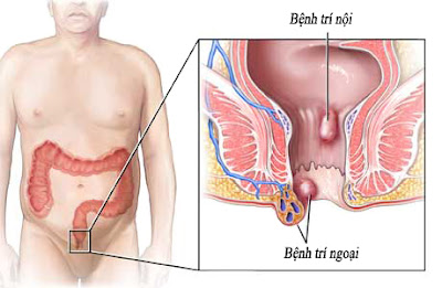 hinh anh benh tri ngoai