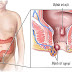Trĩ ngoại - Các triệu chứng,nguyên nhân và cách chữa tốt nhất