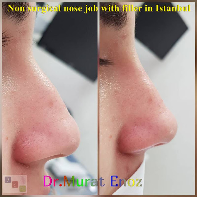 Non-surgical rhinoplasty in Istanbul - The 5 Minute Nose Job in Istanbul - Non-surgical nose job - Nose filler injection Turkey - Injectable nose job - Liquid rhinoplasty