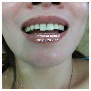 gambar foto contoh sebelum dan sesudah veneer gigi kelinci buatan manis cantik bali jember banyuwangi murah berkualitas di PERMATA DENTAL gambar gigi rusak yang di veneer gigi yang tidak rapi gigi renggang gigi patah cuil rompal pendek karies hitam kuning