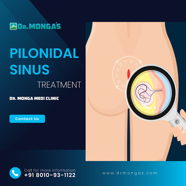 Pilonidal Sinus Treatment