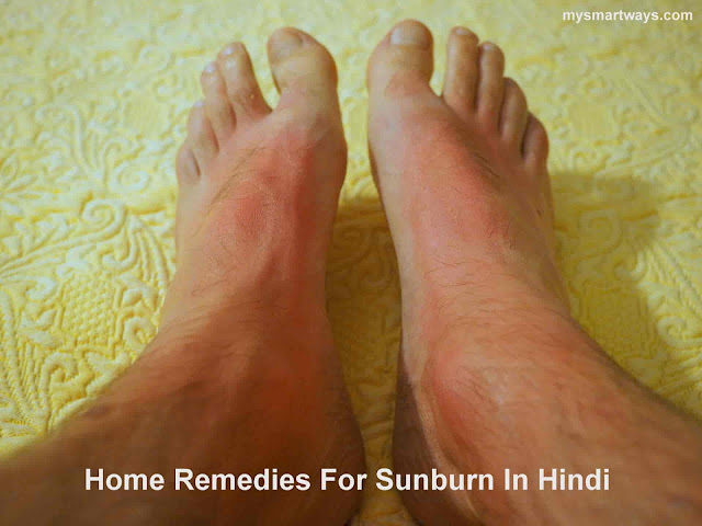 Home Remedies For Sunburn Treatment At Home In Hindi