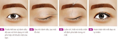 Chi phí bấm mí dove eyes bao nhiêu tiền