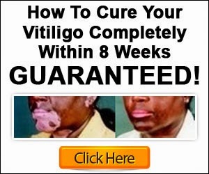  Symptoms of Vitiligo