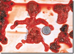 aborted_9_week_fetus