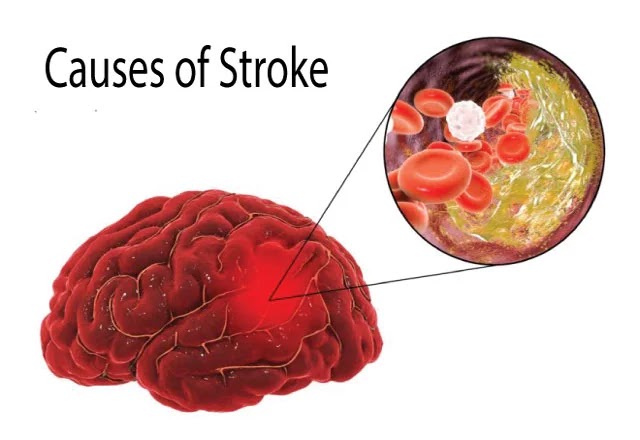 The 5 Leading Causes of a Stroke