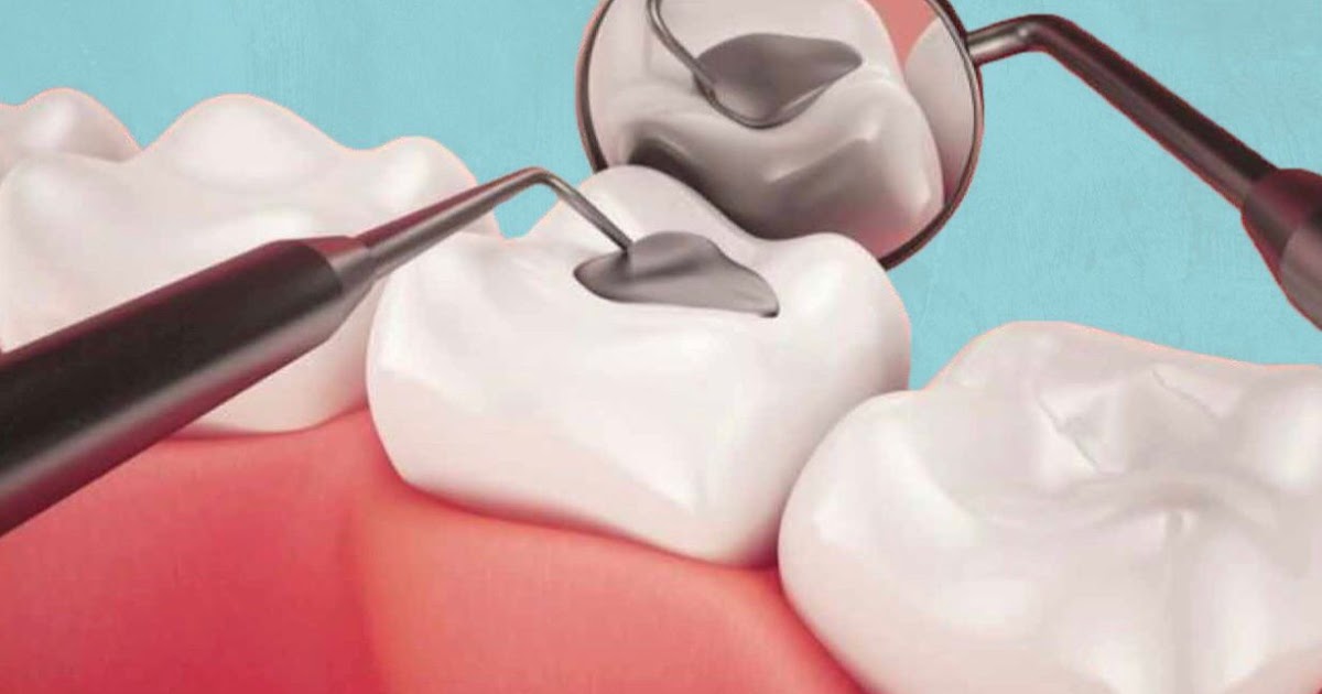Resina Para Reparar Prótesis Dentales Resinas dentales