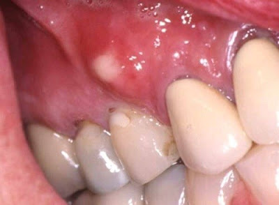 Cách điều trị viêm chân răng có mủ an toàn-1