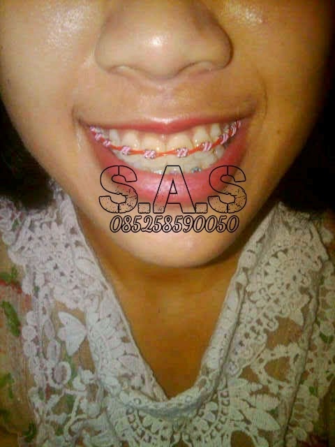 Foto Cewek Cantik Berbehel S A S Dental