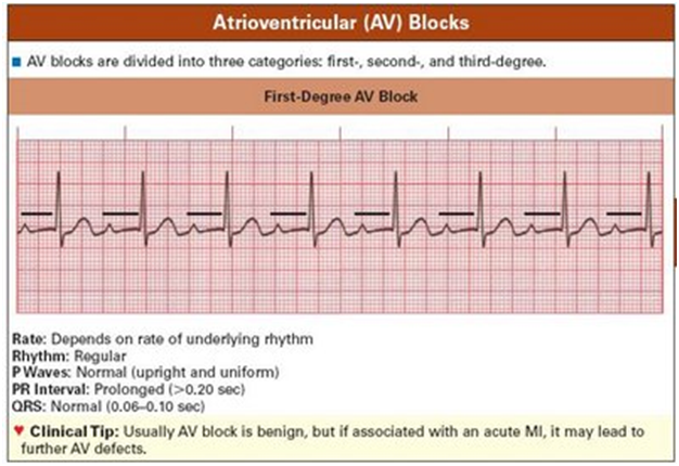 BLOG HIMA KARDIOVASKULER: MAKALAH ELEKTROKARDIOGRAFI (EKG 