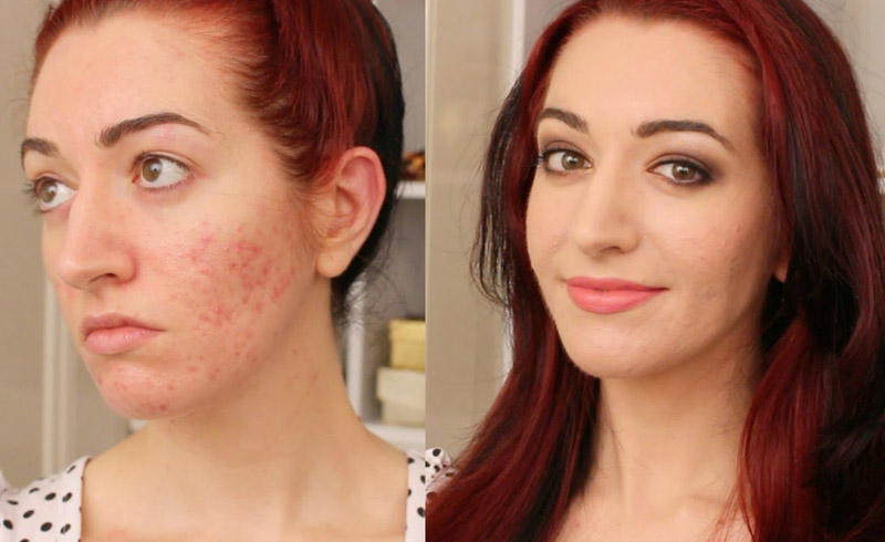 How to Cover up Breakouts with Makeup