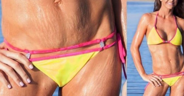 Trucs et astuces pour porter un bikini sans faire paraître ses vergetures