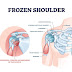 Penyebab Frozen shoulder, Terapi dan Pengobatannya