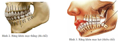 Răng khôn để làm gì? Có cần giữ lại không?