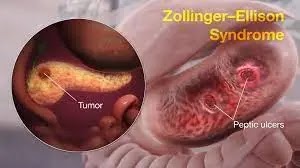 What Is Zollinger-Ellison Syndrome(ZES)