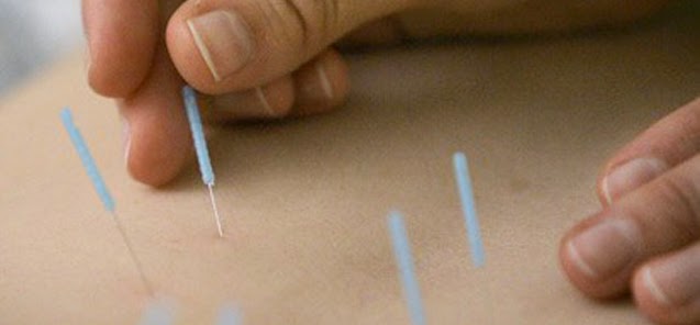 Acupuncture 