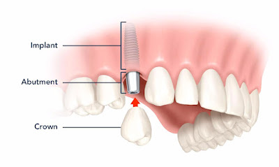 Quy trình trồng răng implant vĩnh viễn