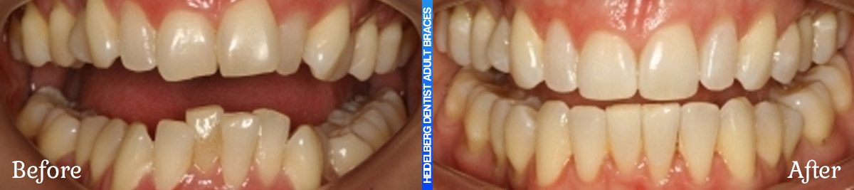 Adult Braces Melbourne Before & After Smile Gallery