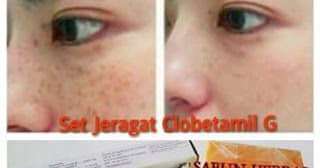 CLOBETAMIL G KRIM UNTUK JERAGAT - ZMBEAUTY SHOP