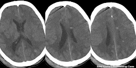 Cryptic Vascular malformation