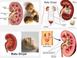 cara menghancurkan batu ginjal tanpa operasi,obat batu ginjal,obat kencing batu,cara mengeluarkan batu ginjal tanpa operasi,cara menghilangkan batu ginjal tanpa operasi