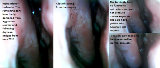 Secondary atrophic rhinitis after aggresive turbinate reduction