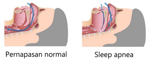 Sleep apnea